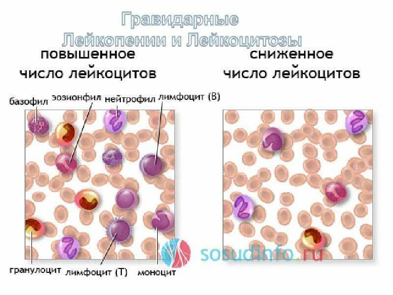 Снижение лейкоцитоза. Нейтрофилы в мазке крови. Лимфоциты мазок крови. Повышение количества лейкоцитов. Лейкоцитоз мазок крови.