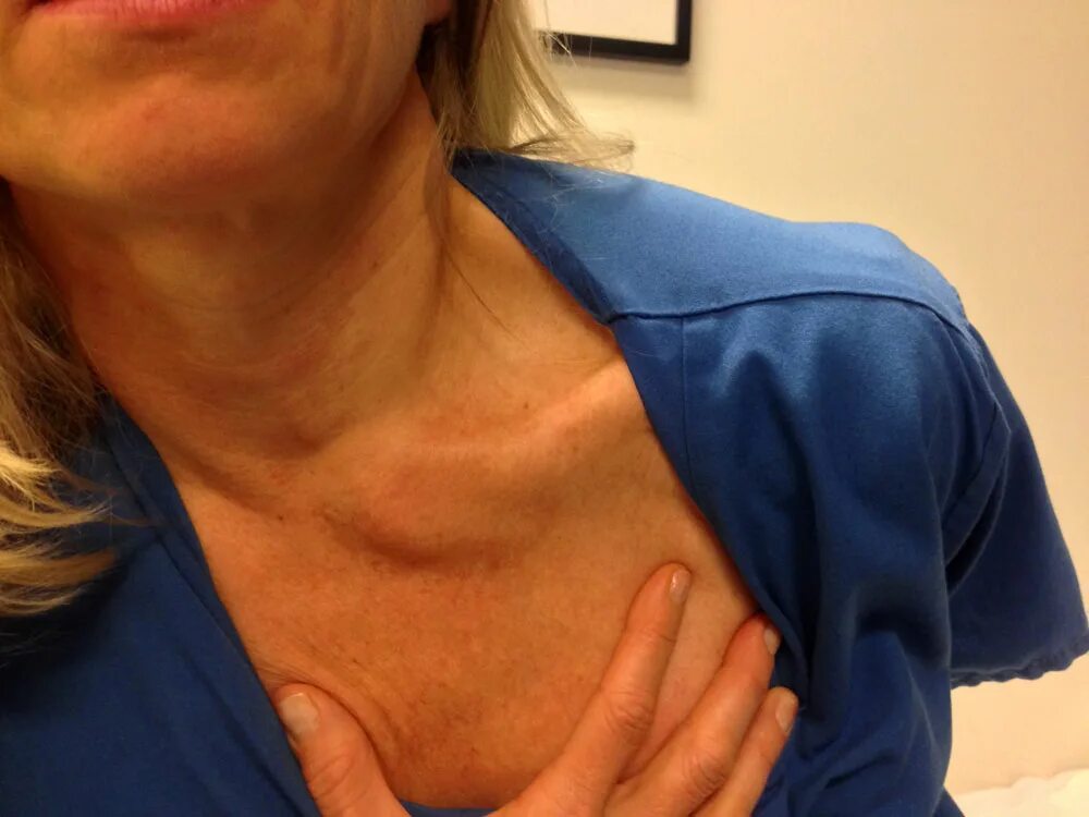 Дискомфорт в шее с правой стороны. Закрытый перелом ключицы симптомы. Плечелопаточный периартрит. Боль в ключице после. Боль в ключице после.