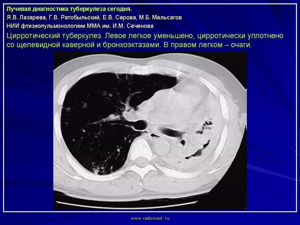 Цирротический туберкулез кт. Цирротический туберкулез легких. Цирротический туберкулёз лёгких кт. Цирротический туберкулез легкого на кт.