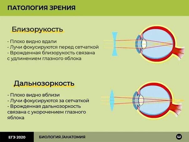 Дальнозоркость линзы двояковыпуклые. Строение глаза при близорукости и дальнозоркости. Миопия близорукость глаз. Аномалии рефракции глаза близорукость дальнозоркость таблица. Причины близорукости и дальнозоркости таблица.