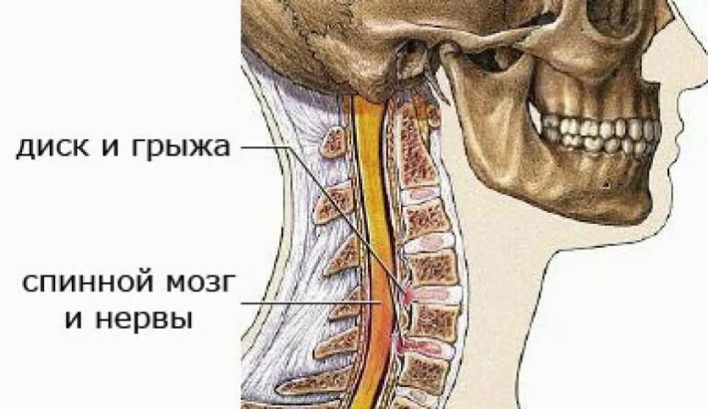 межпозвоночная грыжа шейного отдела с5-с6. секвестрированная грыжа мрт. грыжа дисков шеи. грыжа шейного отдела позвоночника мрт. выбухания межпозвонковых дисков у детей.