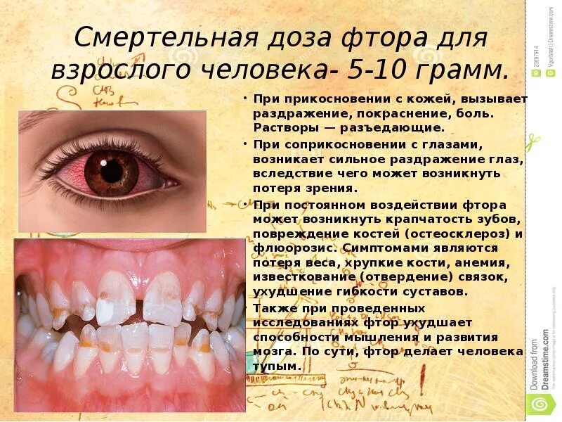 Переизбыток фтора на зубах как выглядит Профилактика флюороза в эндемическом очаге: найдено 78 изображений