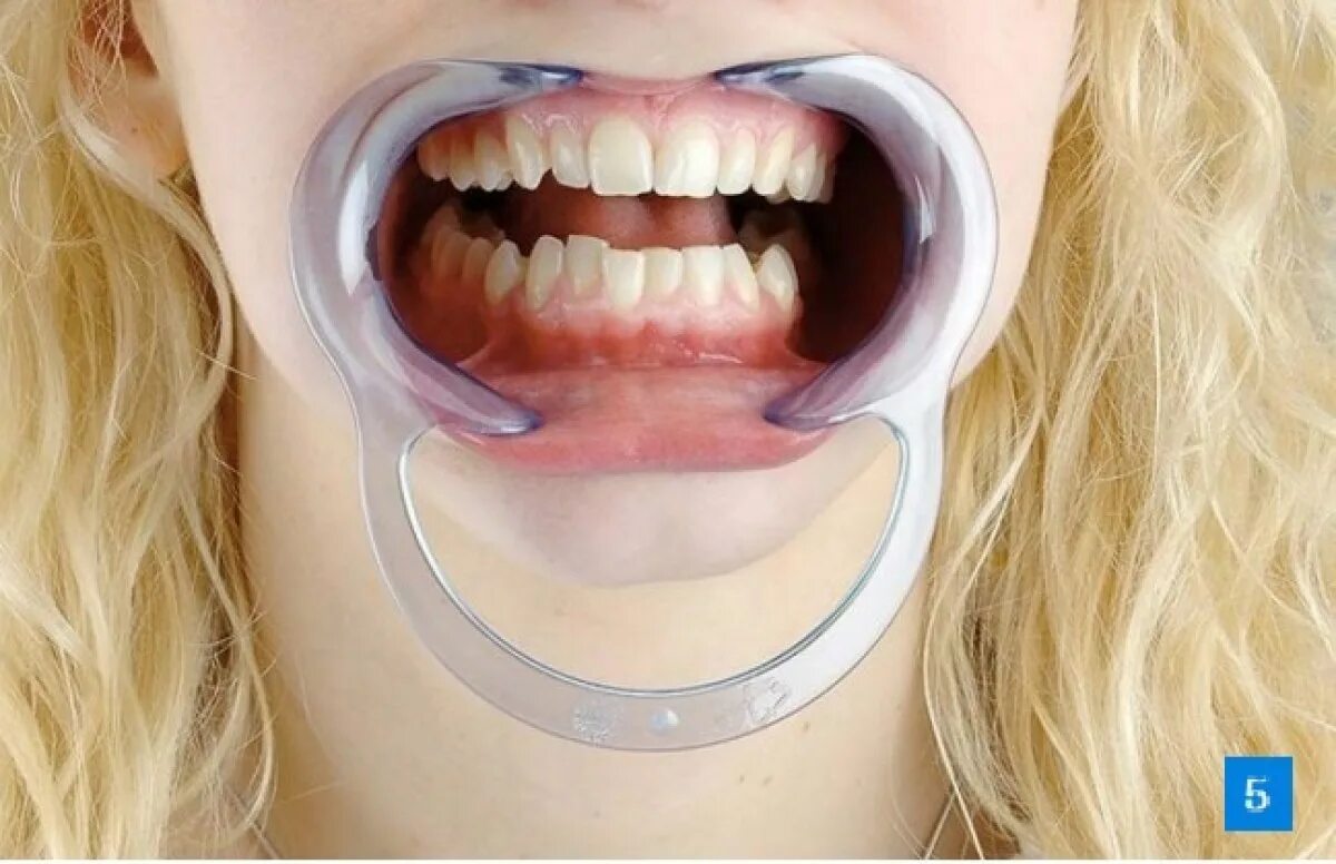 Во сколько открывают рот. XR brands расширитель рта Cheek Retractor Dental mouth gag. Роторасширитель (ретрактор губной) большой 1шт Китай. Ротовой ретрактор оптрагейт. Ретрактор стоматологический силиконовый.