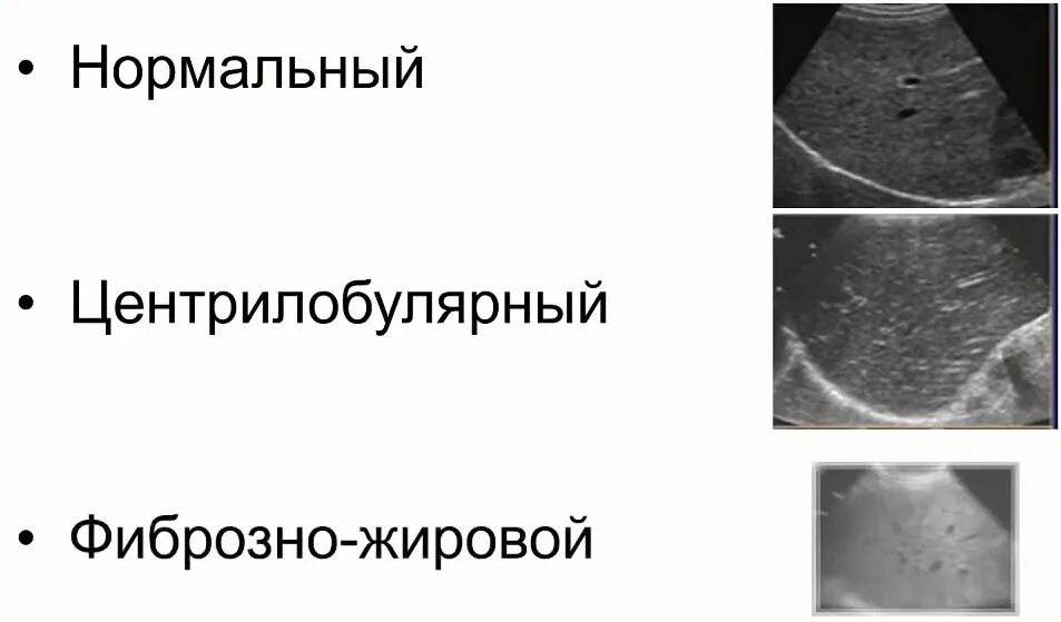 Диффузная эхогенность печени. Структурные изменения печени на УЗИ. Центрилобулярный Тип печени. Симптом звездного неба на УЗИ печени. Эхогенность паренхимы печени.