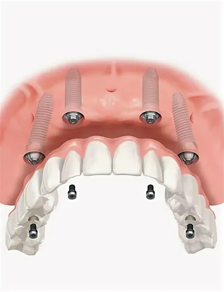 Nên bọc răng sứ cho răng cửa không? Teeth implants, Dental implants, Dental vene