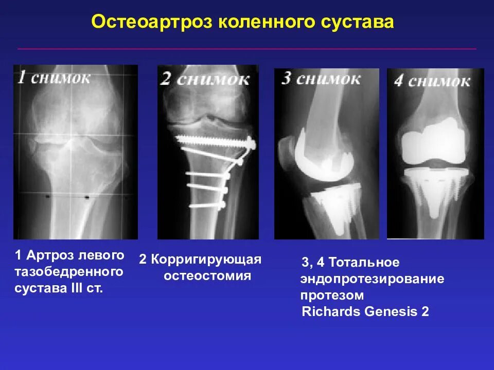 Деформирующий артроз коленного сустава рентгенограмма. Деформирующий остеоартроз коленного сустава рентгенограммы. Деформирующий остеоартроз 2 степени. Деформирующий остеоартроз степени рентген.