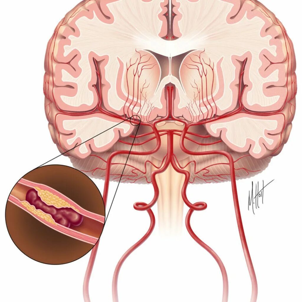 Артерии головного мозга симптомы. Ишемический инсульт головного мозга. Лакунарный инсульт. ОНМК ишемический инсульт. Артерии головного мозга ишемический инсульт.