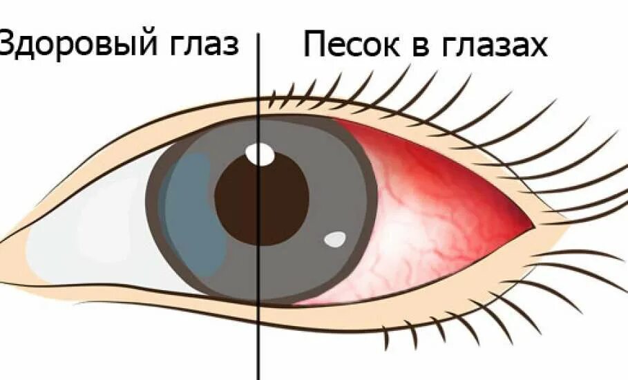 Коньюктивитная полость глаза. Здоровые глаза. Почему мешает в глазах