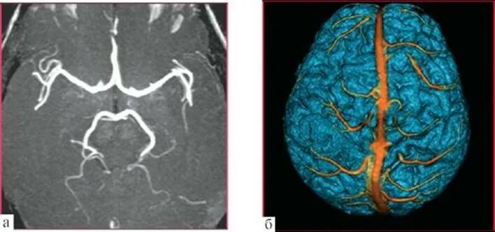 Гипоплазия артерий Виллизиева круга. Мрт сосудов головного мозга Виллизиев круг. Виллизиев круг мрт. Виллизиев круг на кт. Гипоплазия правого поперечного синуса