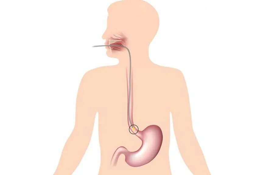 Рот пищевод кишечник. Двенадцатиперстная кишка ФГДС. Зондирование желудка. Зондирование пищеварительного тракта. Гастроскопия.