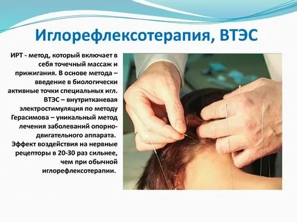 Внутритканевая электростимуляция по герасимову