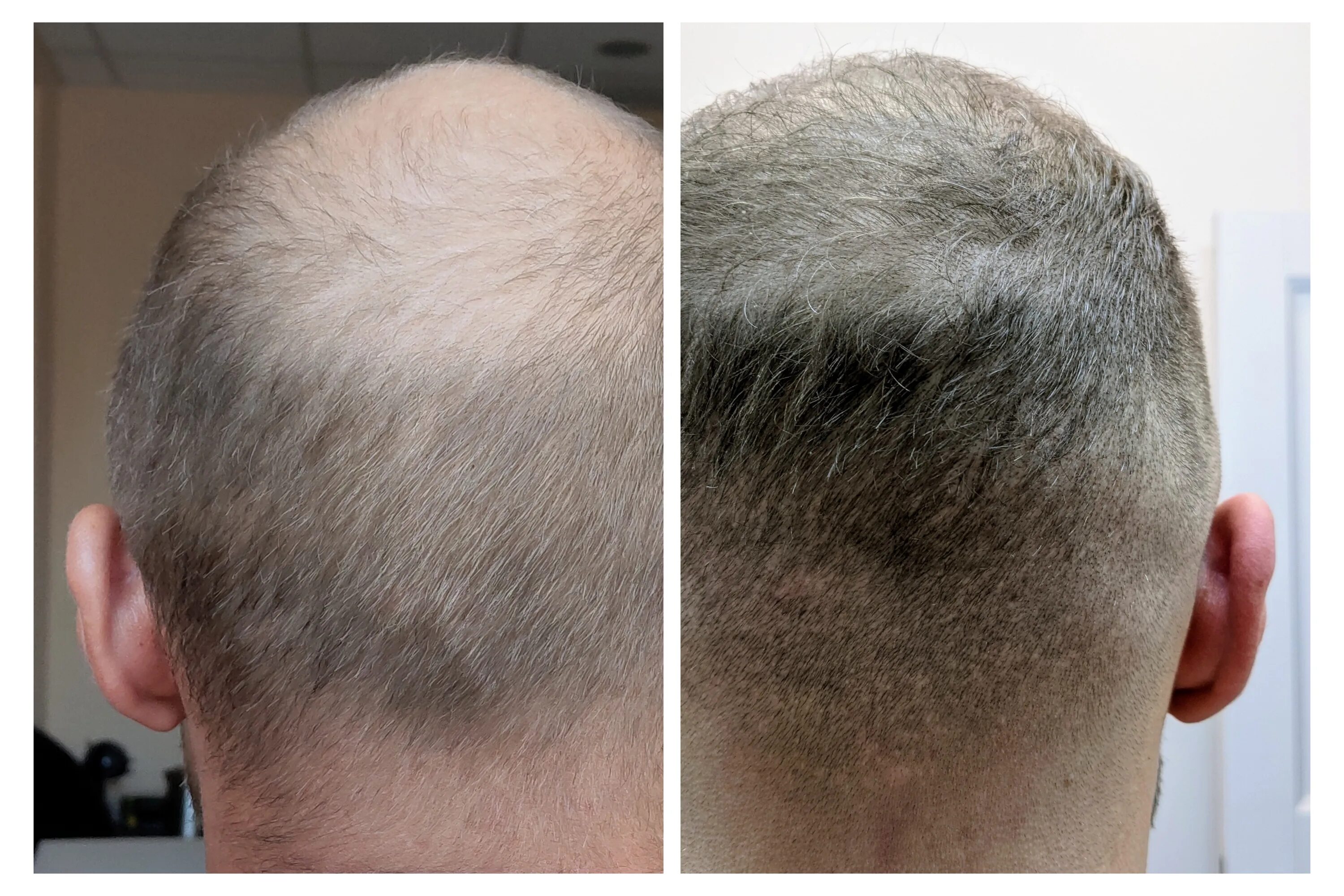 Пересадка волос цена для мужчин 2024. Степени облысения по Норвуду. Трансплантация волос с затылка. Пересадка волос у мужчин.