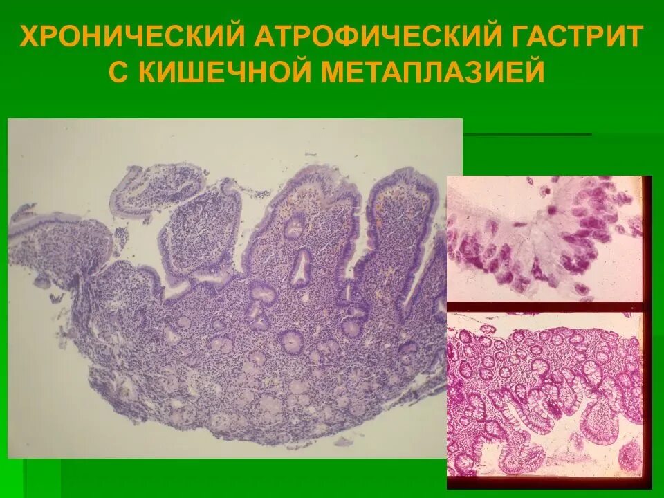 Атрофический гастрит гистология. Толстокишечная метаплазия гистология. Атрофический гастрит патанатомия. Кишечная метаплазия желудка микропрепарат. Признаки атрофией слизистой оболочки