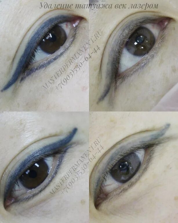 пикосекундный лазер для удаления татуажа бровей. удаление татуажа век отзывы. удаление татуажа век ремувером. удаление татуажа век отзывы. татуаж век после лазера.
