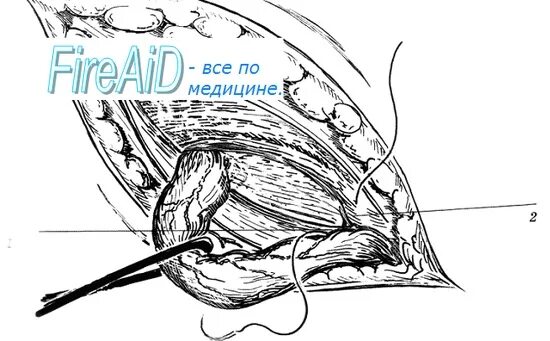 Операция Лихтенштейна при паховой грыже схема. Пластика пахового канала по Лихтенштейну. Операция Лихтенштейна при паховой грыже. Герниопластика по Лихтенштейну. Лихтенштейн операция грыжа