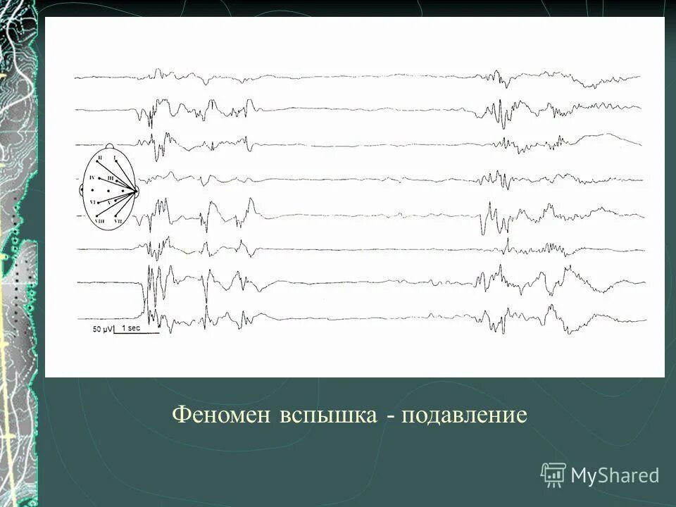 Ээг сигнал. Вспышка подавление на ЭЭГ. Паттерн вспышка-подавление на ЭЭГ. Синдром Отахара на ЭЭГ. Гипсаритмия на ЭЭГ.