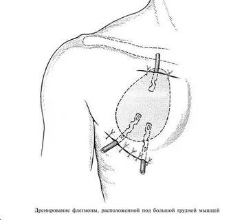 Операция дренирование