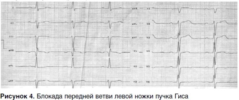 Блокада передне лнпг. Неполная блокада передней ветви ЛНПГ на ЭКГ. Неполная блокада ветви левой ножки передней на ЭКГ. Блокада передней ветви левой ножки пучка Гиса на ЭКГ. Блокада передней ветви левой ножки на ЭКГ.