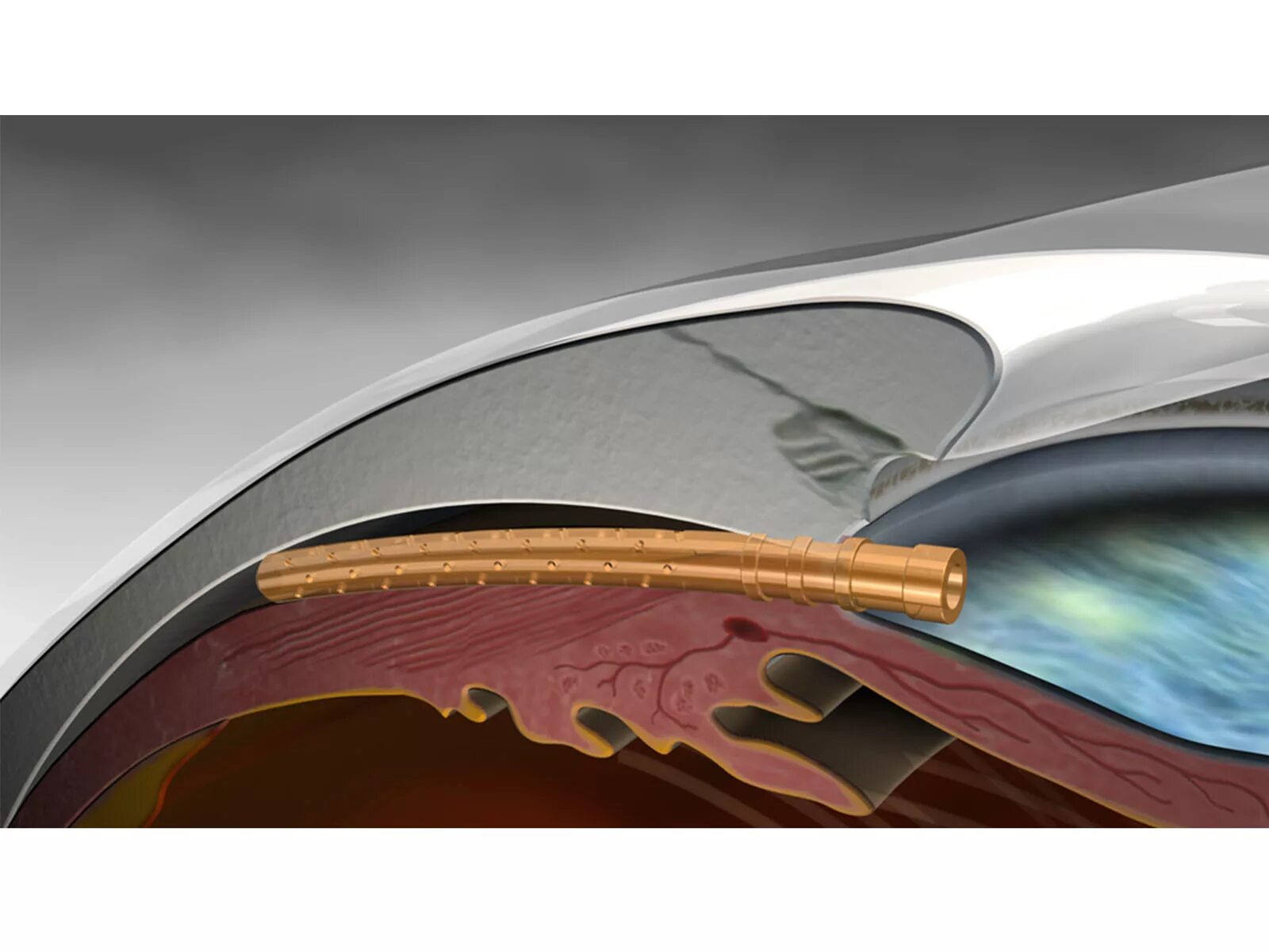 НГСЭ операция глаукомы. Непроникающая глубокая склерэктомия (НГСЭ). Антиглаукоматозные операции.