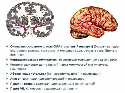 Инсульт лобной доли