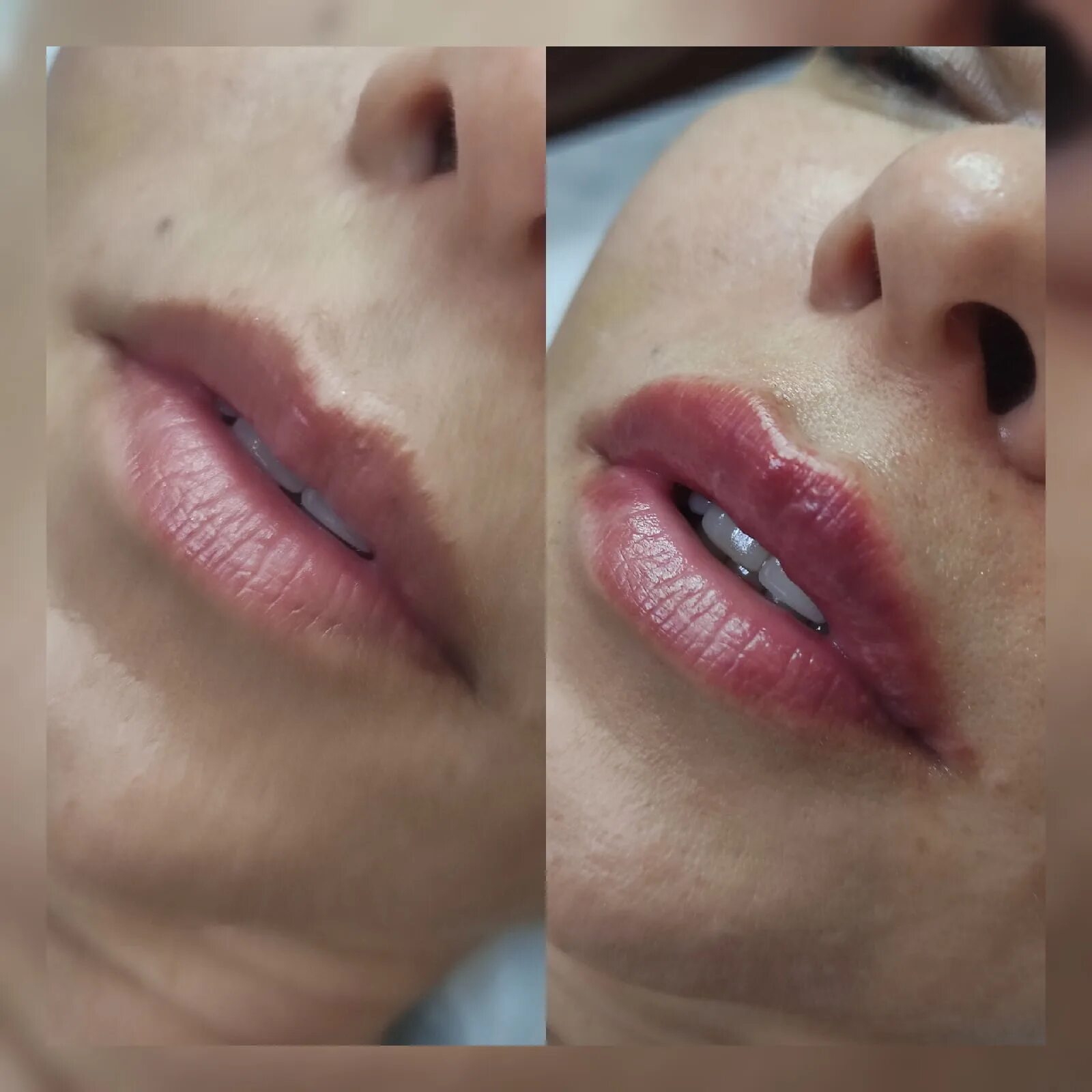 Губы накаченные гиалуроновой кислотой. Belotero shape для губ. Губы накаченные гиалуроновой кислотой 0. Белотеро липс 1 мл. Губы 0.