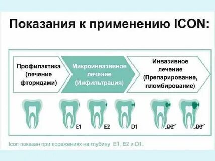 Методы лечения кариеса