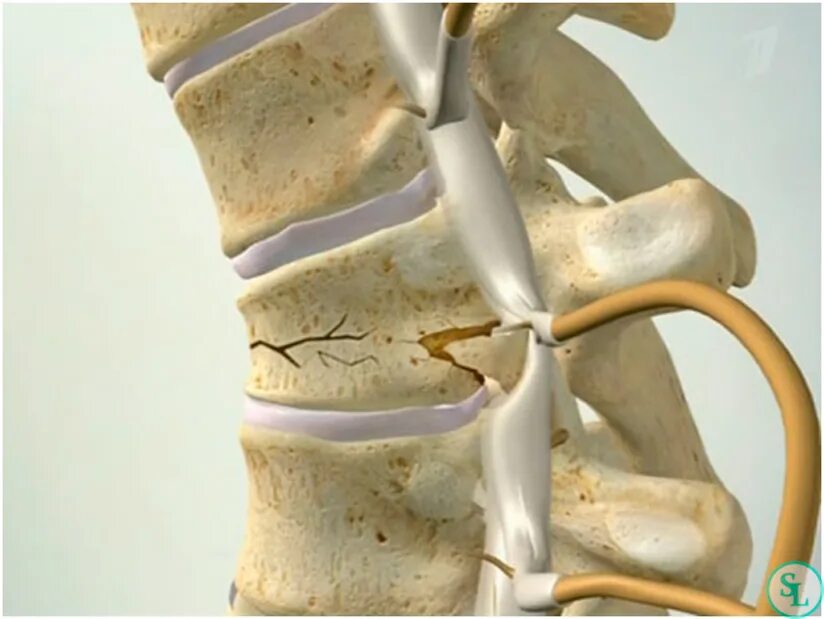 Компрессионный перелом позвоночника th12 l3. Компрессионный клиновидный перелом 12 позвонка. Неосложненный компрессионный перелом. Компрессионный перелом л3 л4. Компрессионная операция на позвоночнике