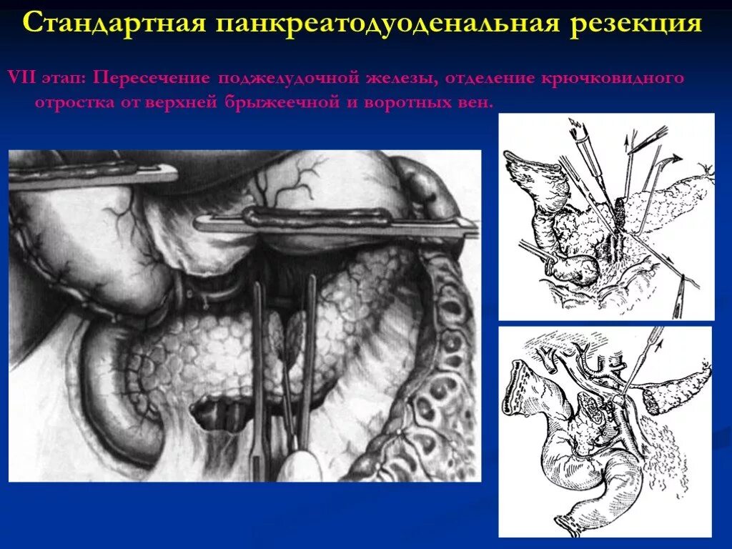 Пдр операция. Панкреатодуоденальная резекция операция Whipple. Операция Уиппла (панкреатодуоденальная резекция). Пилоросохраняющая панкреатодуоденальная резекция. Панкреодуоденэктомия, панкреодуоденальная резекция.