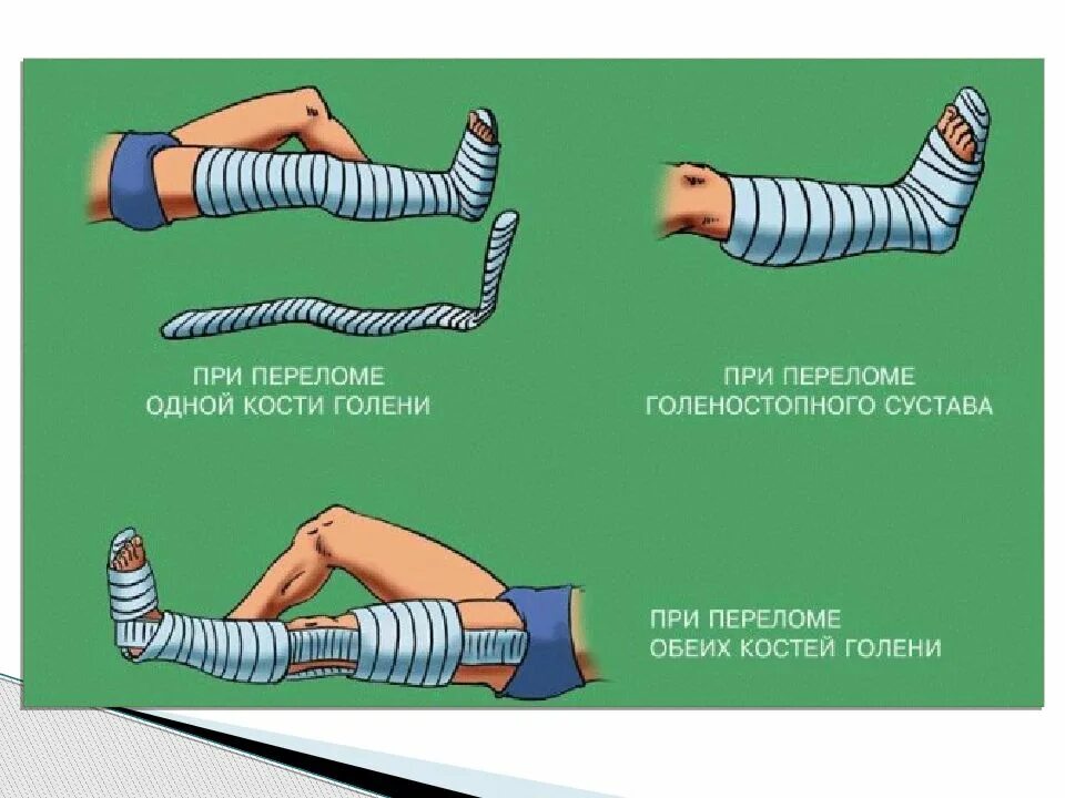 Виды переломов и первая помощь при них. ПП при открытых переломах.