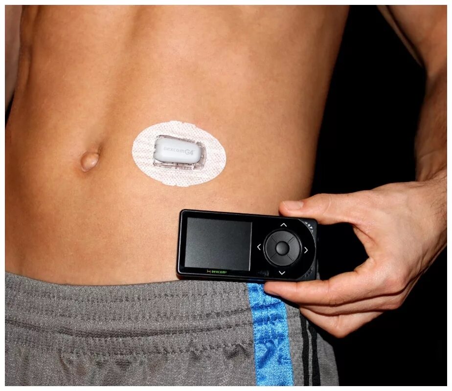 Сенсор измерения. Dexcom мониторинг глюкозы. трансмиттер для диабетиков dexcom. сенсор dexcom g6 на теле. мониторинг сахара dexcom g4.