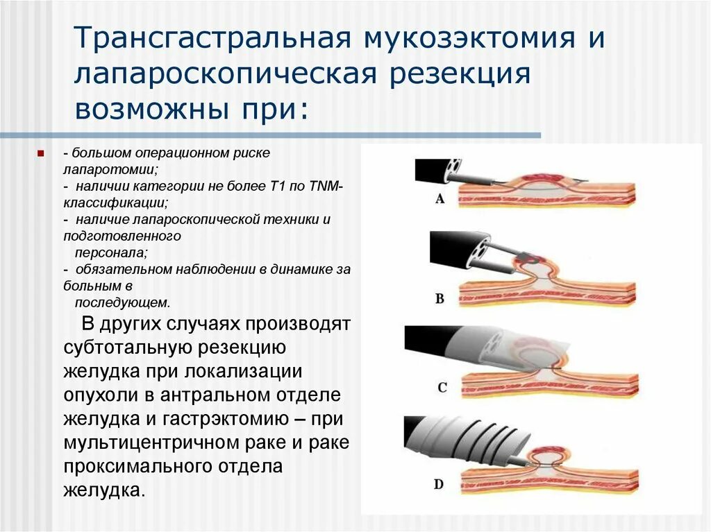 Эндоскопическая диссекция в подслизистом слое. Принципы лапароскопических операций. Эндоскопическая диссекция. Эндоскопическая послойная диссекция. Эндоскопическая резекция является методом выбора при.