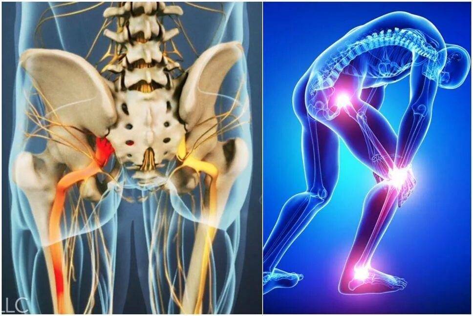 Боль в пояснице защемление седалищного. Седалищный нерв. Седалищный нерв симптомы. Ишиас воспаление седалищного нерва.