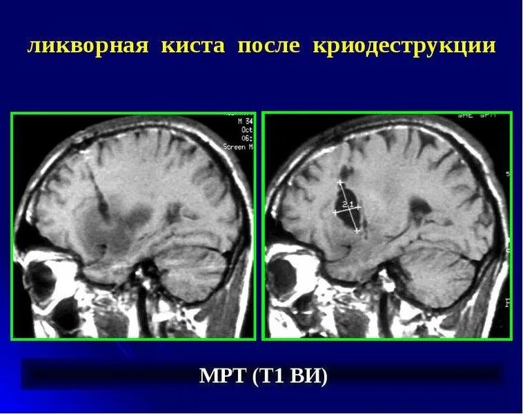 Ретроцеребеллярная арахноидальная киста мрт. Ретроцеребеллярная арахноидальная киста кт. Ликворная киста головного мозга кт.