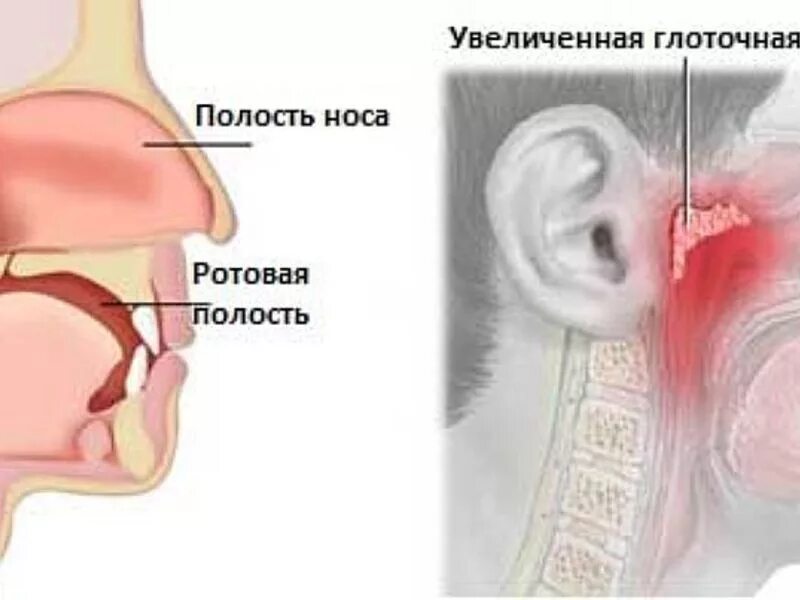 Аденоидный вегетация 3. Рентген носоглотки аденоиды. Анатомия носоглотки аденоиды. Строение горла аденоиды.