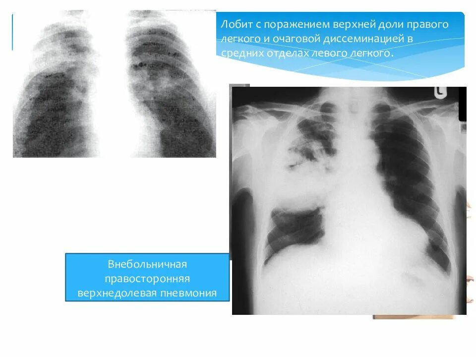 Лобить. Казеозная пневмония туберкулез. Казеозная пневмония рентген. Пневмония в верхней доле правого легкого. Поражение туберкулез правый верхний доли легкий.