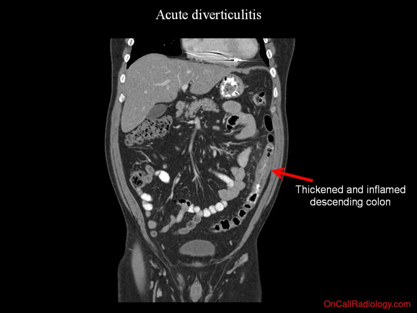 инвагинация толстой кишки кт. дивертикулит сигмовидной кишки кт. инвагинация кишечника кт. сигмовидная кишка на кт. опухоль сигмовидной кишки на кт.
