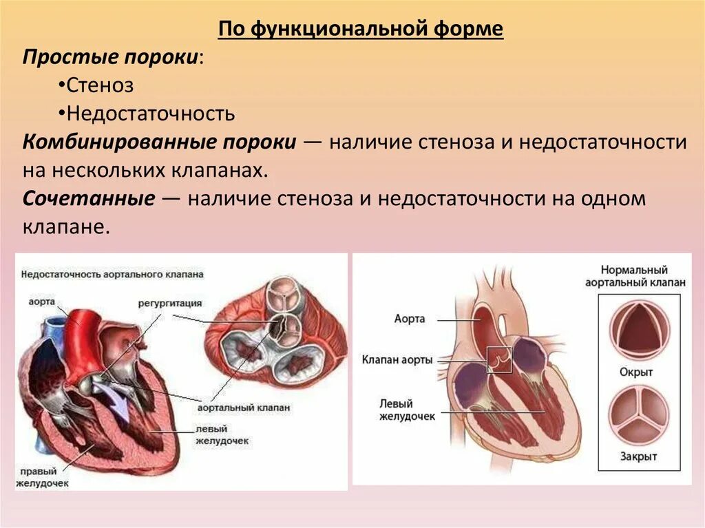 Тк регургитация 1. Недостаточность аортального клапана регургитация. Степени регургитации аортального клапана. Аортальная регургитация 1 степени что это такое. Классификация аортальной регургитации.