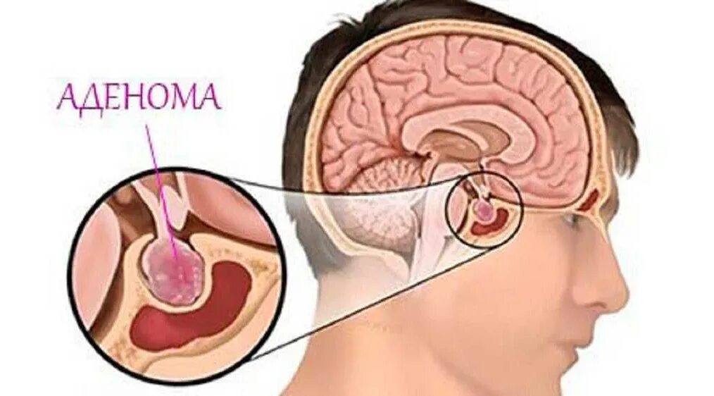 Опухоль гипофиза. Эндоселлярная аденома гипофиза. Аденомэктомия гипофиза. Эндоселлярная аденома гипофиза головного мозга. Эозинофильная аденома гипофиза.