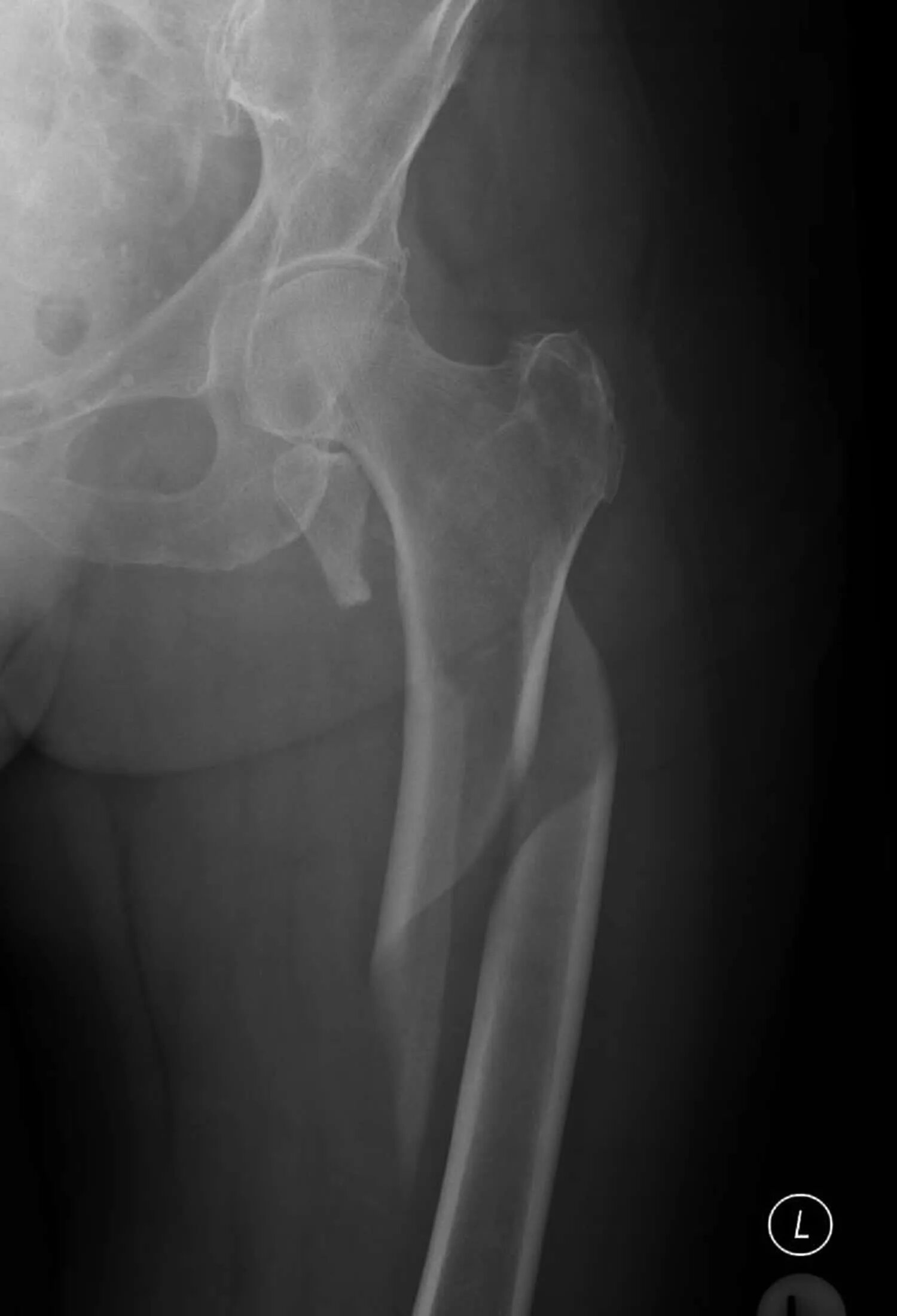 Перелом тазобедренного сустава со смещением. Чрезвертельный перелом бедренной кости остеосинтез. Межвертельный перелом бедренной кости рентген. Вывих головки бедренной кости. Перелом шейки бедренной кости рентген.