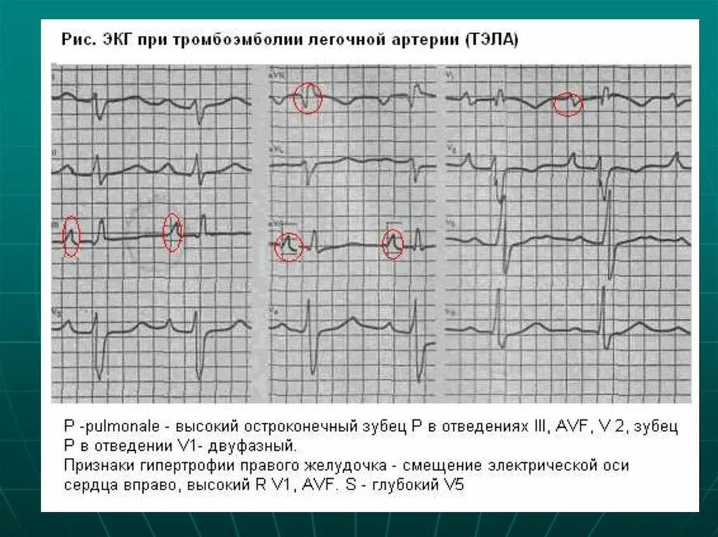 Тромбоэмболия легочной артерии экг. ЭКГ при тромбоэмболии легочной артерии. ЭКГ признаки тромбоэмболии легочной. Тэда на ЭКГ. S1 q3 p pulmonale ЭКГ.