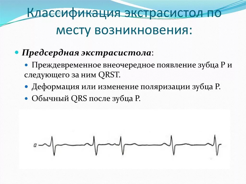 Блокированные предсердные экстрасистолы на ЭКГ. Единичная предсердная экстрасистола. Желудочковая экстрасистолия механизм возникновения. Классификация предсердных экстрасистол. Экстрасистолы много