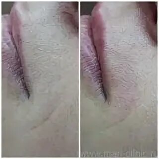 Лазерная эпиляция липецк