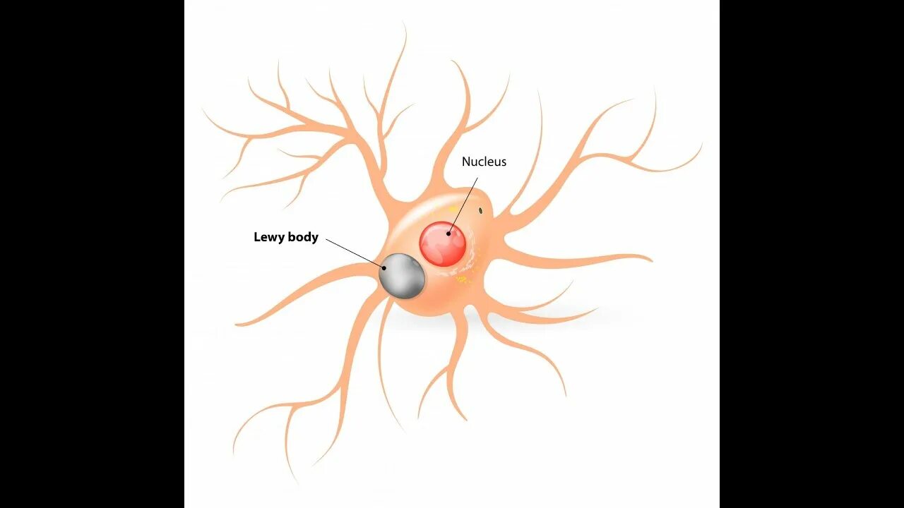 Синдром тельца. Мозг при деменции с тельцами Леви. Деменция тельца Леви. Болезнь Альцгеймера и деменция с тельцами Леви. Деменция с тельцами Леви картинки.