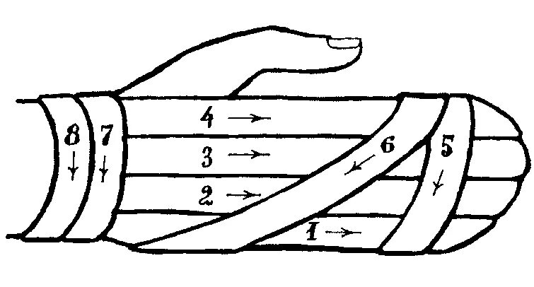 Наложение повязки варежка алгоритм. Техника наложения повязки варежка. Наложение повязки на кисть варежка. Десмургия повязка варежка алгоритм.