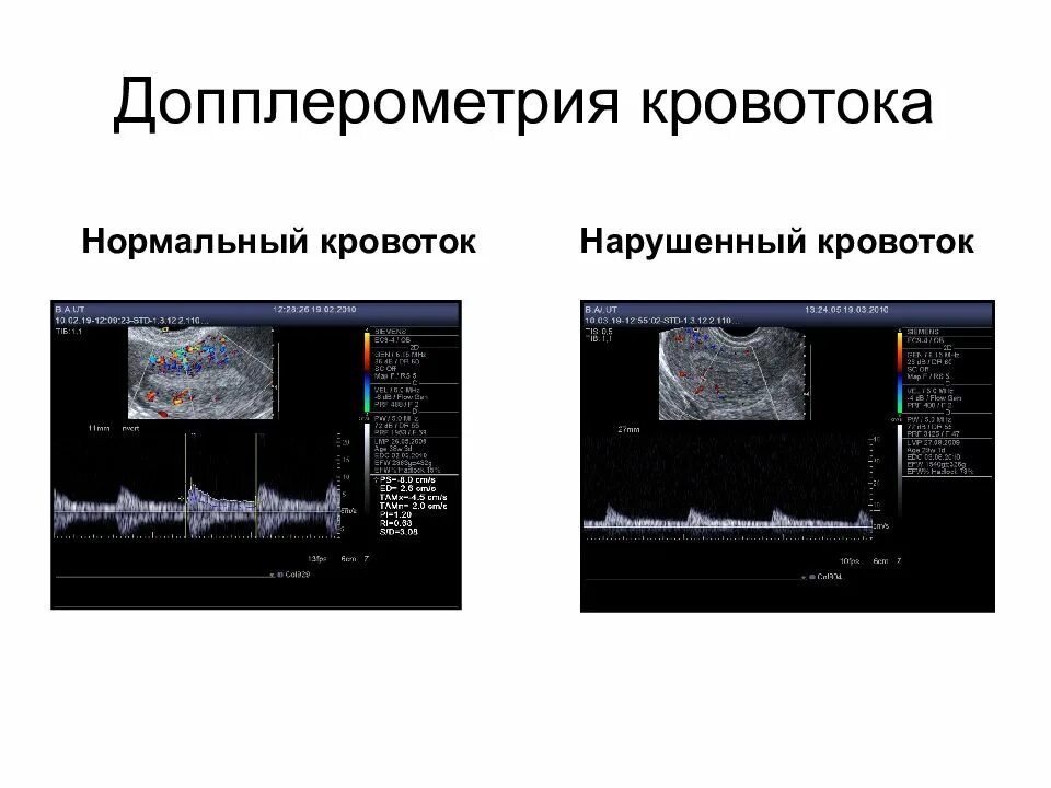 Как делают доплер. Допплерометрия маточно-плацентарного кровотока. Допплерометрия пупочной артерии. Плацентарная недостаточность допплерография. Допплерометрическое исследование при беременности.