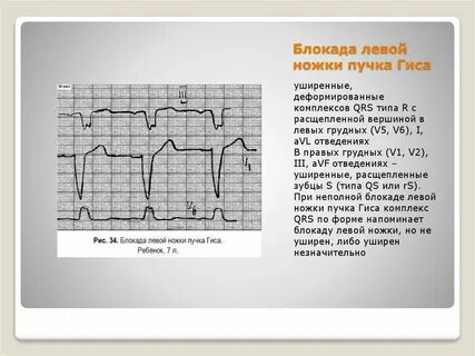 Блокада правого пучка гиса у ребенка