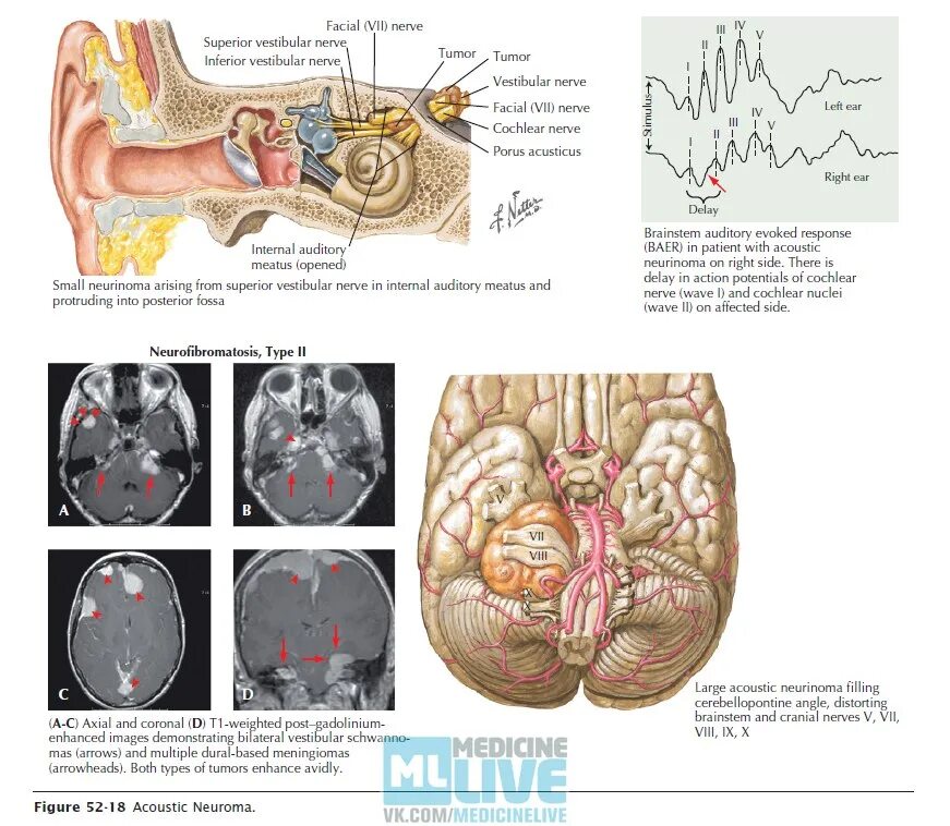 Невринома слухового нерва мрт. Невринома слухового нерва на кт. Невринома 8 пары черепно мозговых нервов. Невринома слухового нерва клиника.