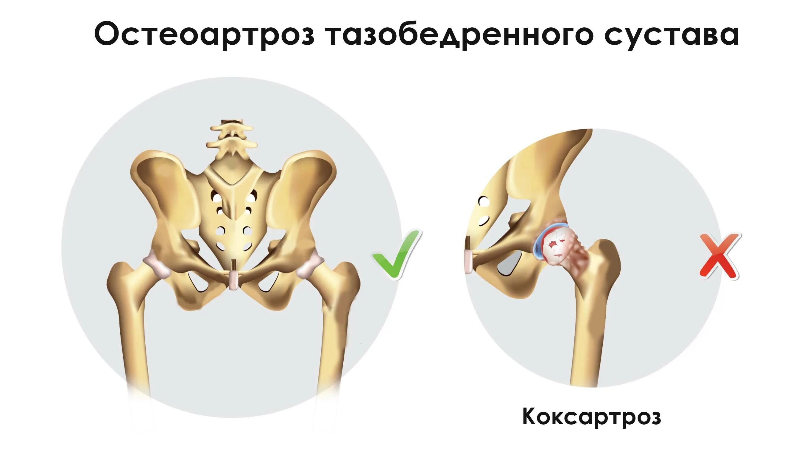 Как лечить артроз 2 степени тазобедренного сустава. Тазобедренный сустав картинки. тазобедренный сустав анатомия. offset тазобедренного сустава.