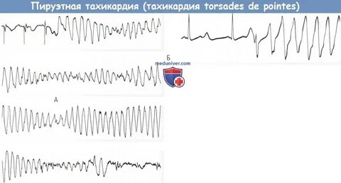 Пируэтная тахикардия