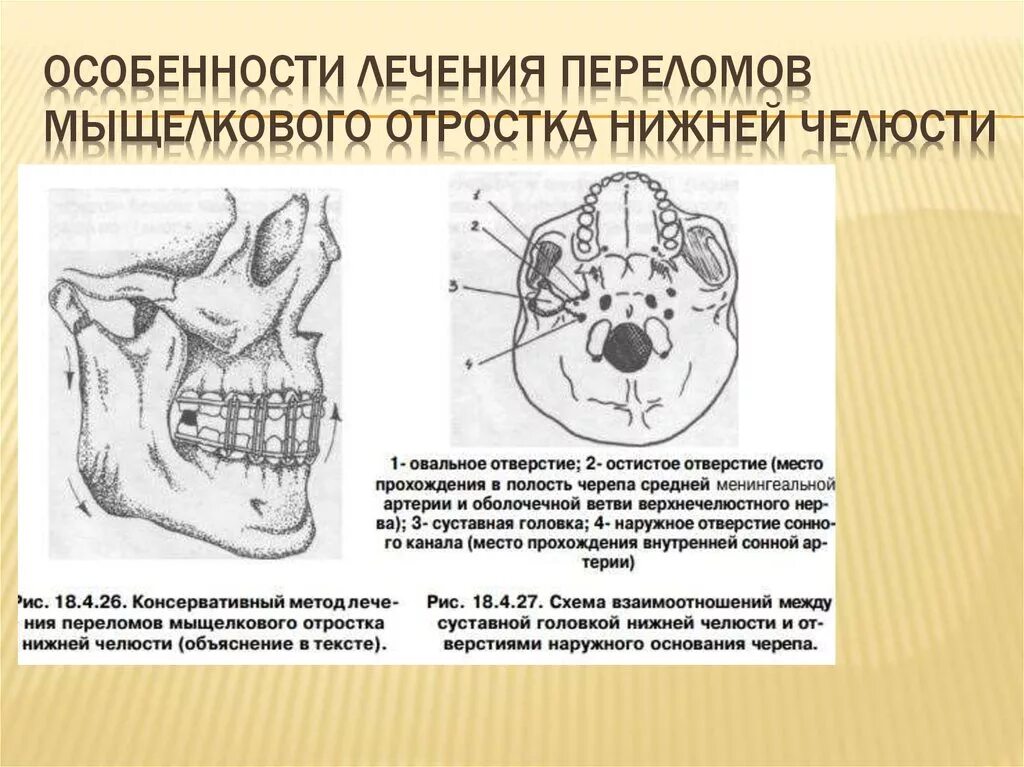 Перелом шейки мыщелкового отростка. Перелом мыщелкового отростка челюсти. Перелом суставного отростка челюсти. Перелом мыщелкового отростка нижней. Мыщелок челюсти